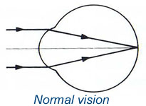 Normal Vision