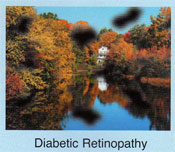 Vision with Diabetic Retinopathy