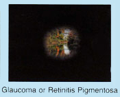 Vision with Glaucoma