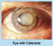 Retina with Cateracts