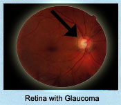 Retina with Glaucoma