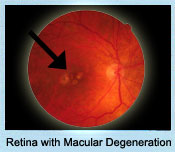 Retina with Macular Degeneration
