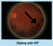 Retina with Retinitis Pigmentation